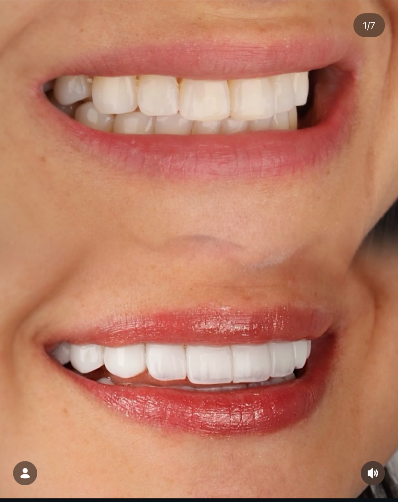 Antes e depois de lentes em porcelana