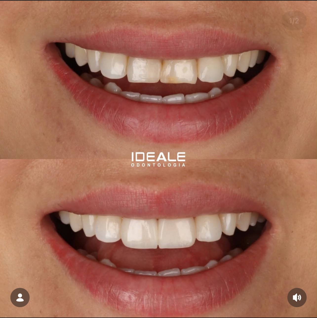 Antes e depois de facetas em resina