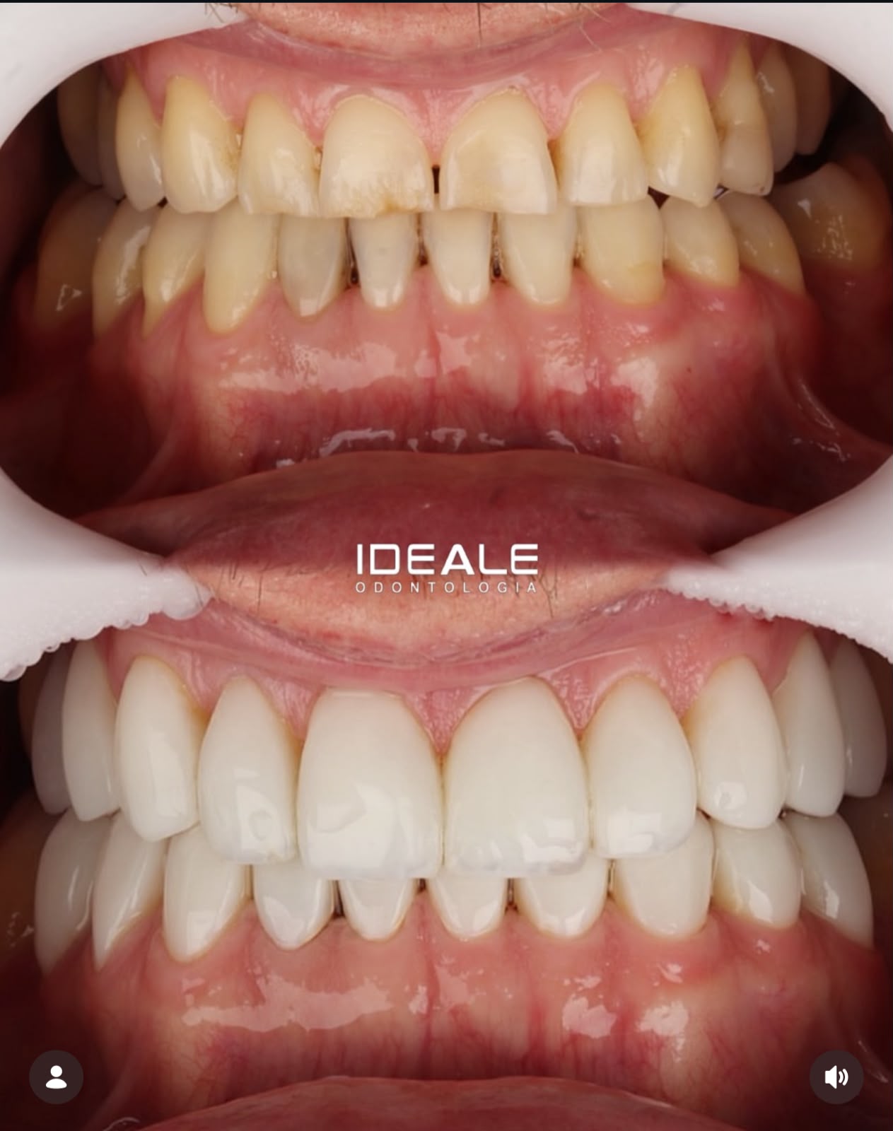 Antes e depois de tratamento ortodôntico