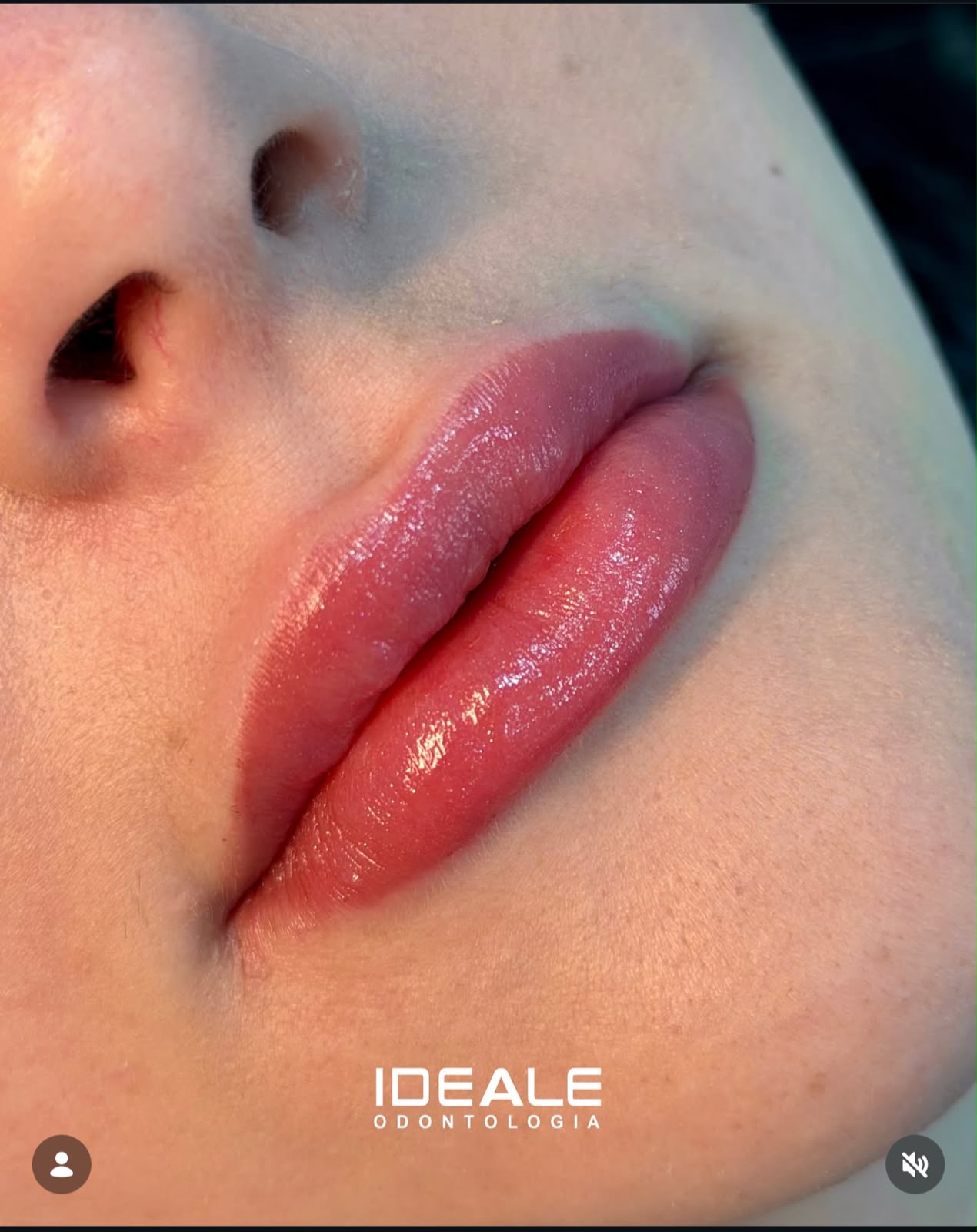 Resultado de harmonização facial